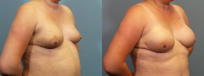 Before & After Breast Reconstruction Case 416 Left Oblique View in Portland, OR