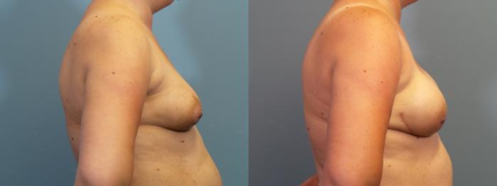 Before & After Breast Reconstruction Case 416 Left Side View in Portland, OR