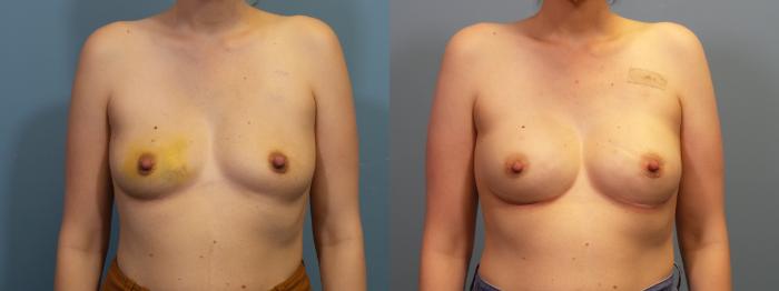 Before & After Breast Reconstruction Case 424 Front View in Portland, OR