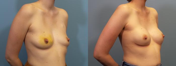 Before & After Breast Reconstruction Case 424 Right Oblique View in Portland, OR