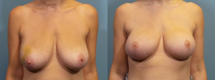 Before & After Breast Reconstruction Case 429 Front View in Portland, OR