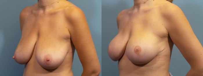 Before & After Breast Reconstruction Case 429 Left Oblique View in Portland, OR