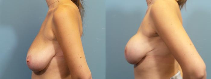 Before & After Breast Reconstruction Case 429 Left Side View in Portland, OR