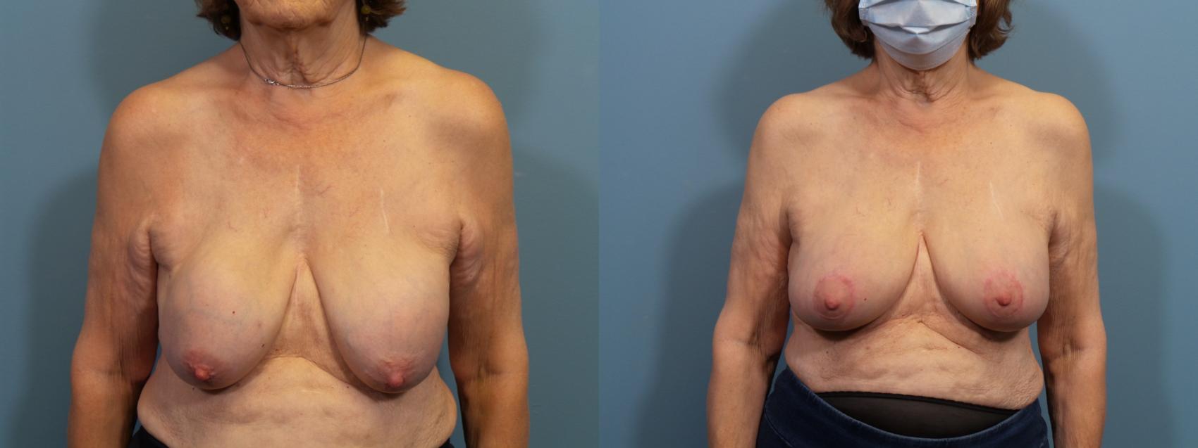 Before & After Breast Reconstruction Case 430 Front View in Portland, OR