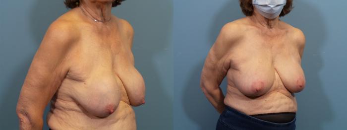 Before & After Breast Reconstruction Case 430 Left Oblique View in Portland, OR