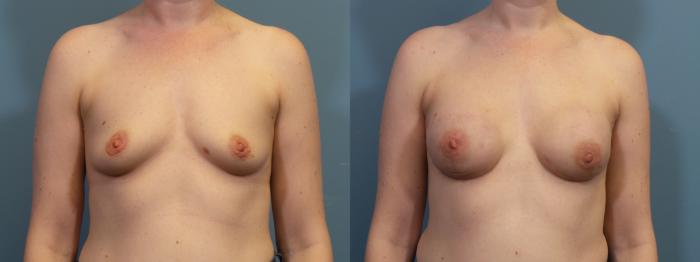 Before & After Breast Reconstruction Case 431 Front View in Portland, OR