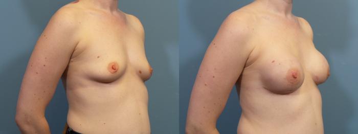 Before & After Breast Reconstruction Case 431 Right Oblique View in Portland, OR