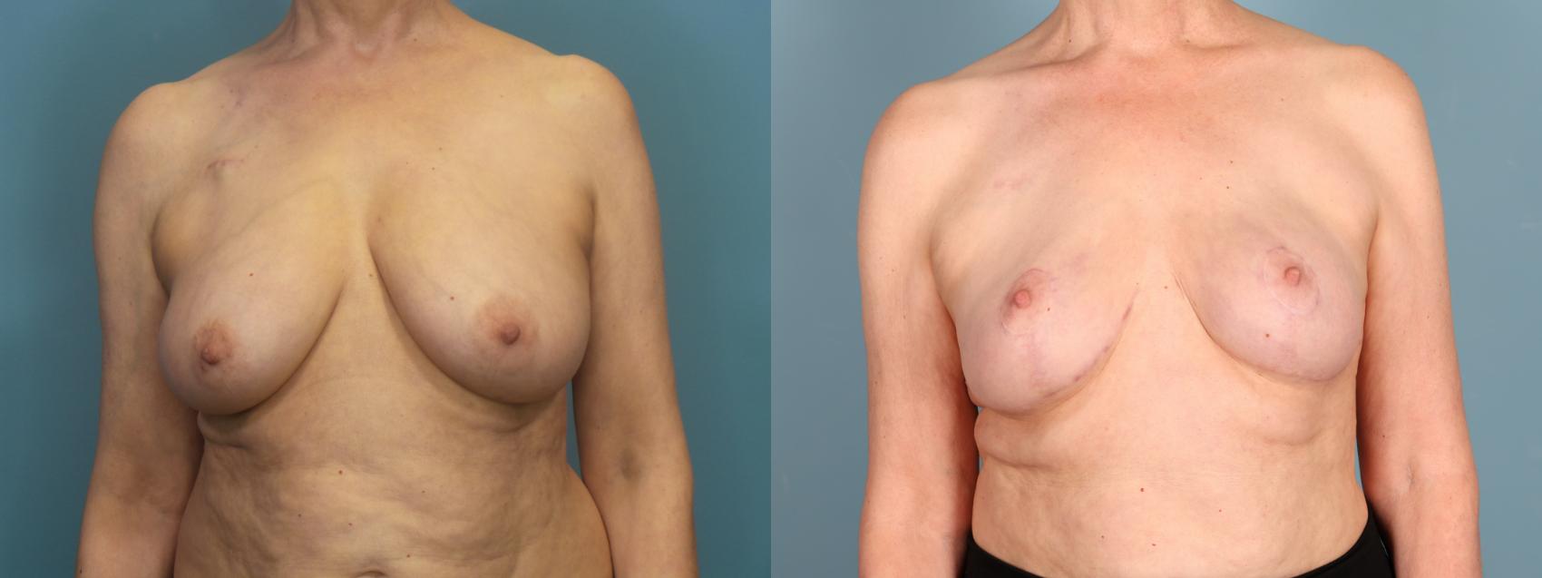 Before & After Breast Reconstruction Case 437 Front View in Portland, OR