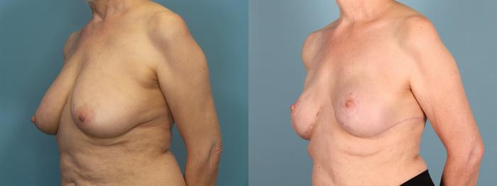 Before & After Breast Reconstruction Case 437 Left Oblique View in Portland, OR
