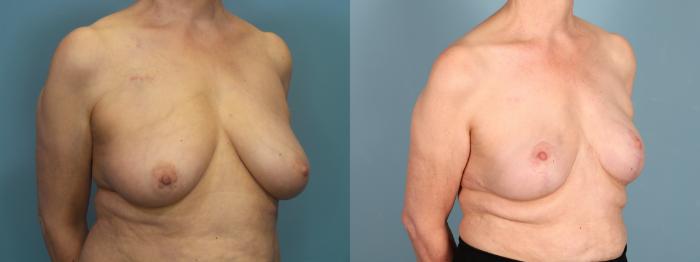 Before & After Breast Reconstruction Case 437 Right Oblique View in Portland, OR