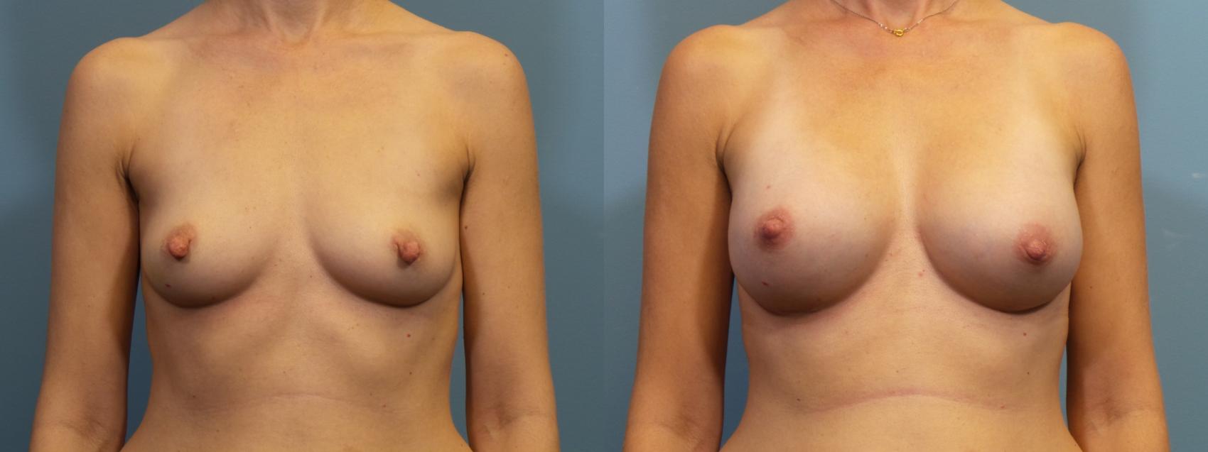 Before & After Breast Reconstruction Case 439 Front View in Portland, OR