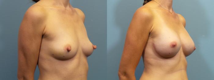 Before & After Breast Reconstruction Case 439 Right Oblique View in Portland, OR
