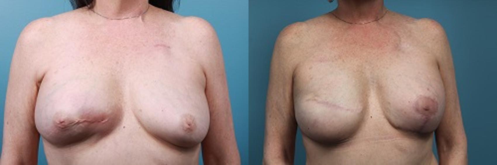 Before & After Breast Reconstruction Case 44 View #1 View in Portland, OR