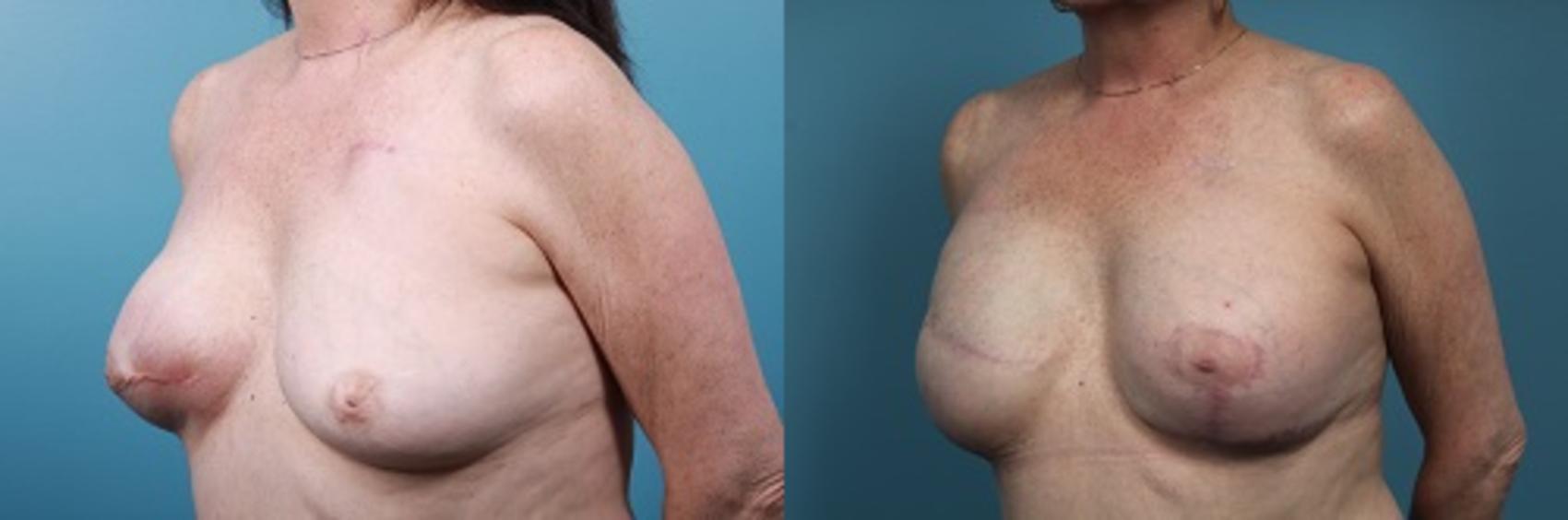 Before & After Breast Reconstruction Case 44 View #2 View in Portland, OR
