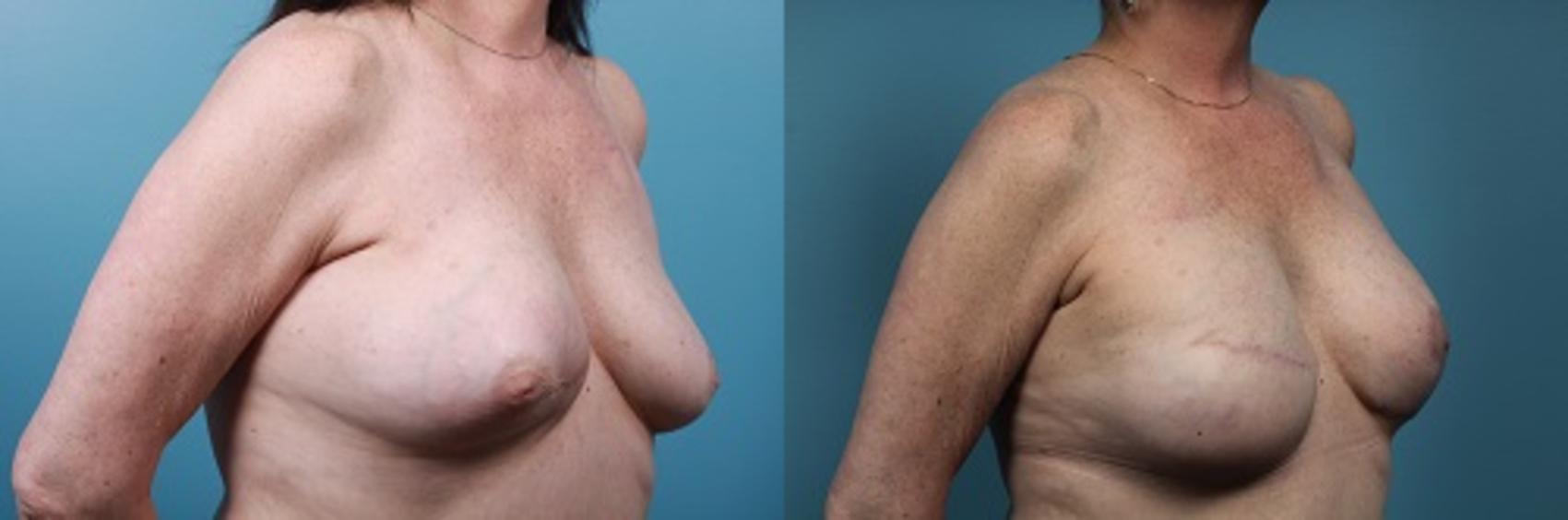 Before & After Breast Reconstruction Case 44 View #3 View in Portland, OR