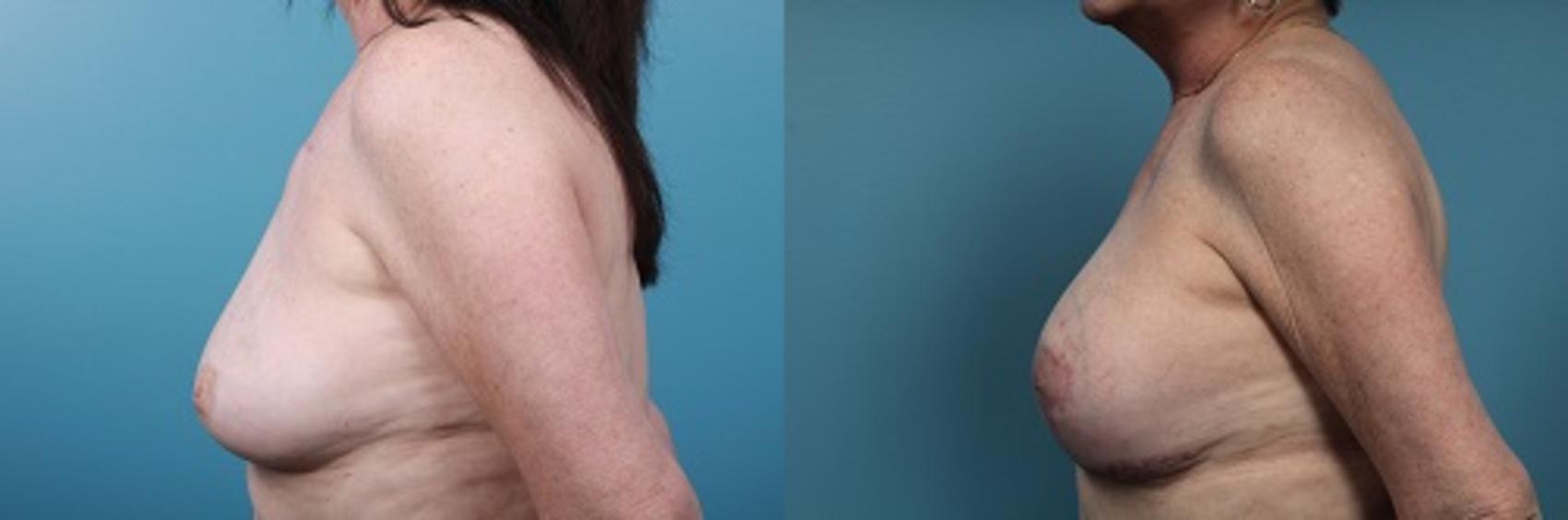 Before & After Breast Reconstruction Case 44 View #4 View in Portland, OR