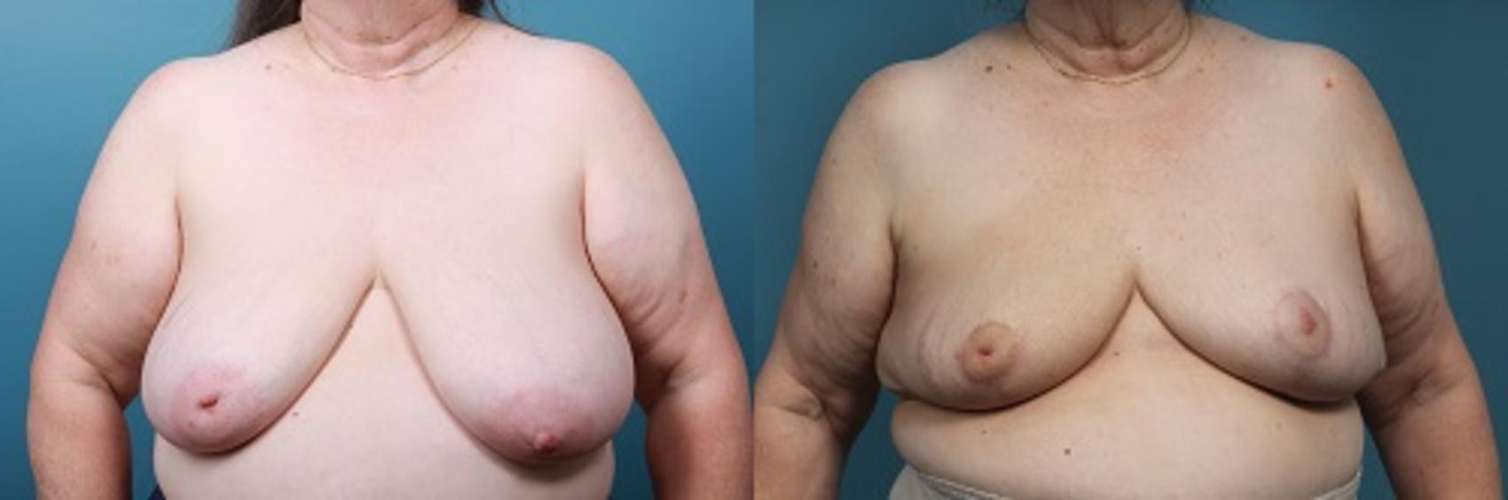 Before & After Breast Reconstruction Case 45 View #1 View in Portland, OR