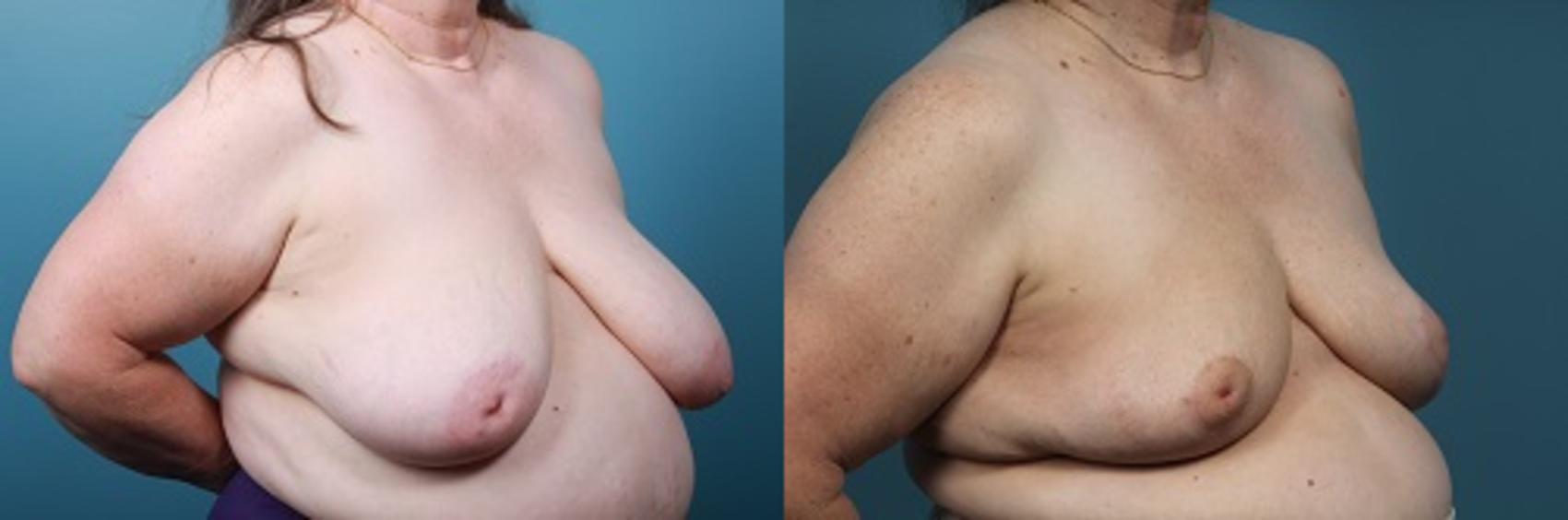 Before & After Breast Reconstruction Case 45 View #2 View in Portland, OR