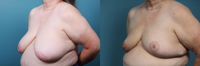 Before & After Breast Reconstruction Case 45 View #3 View in Portland, OR