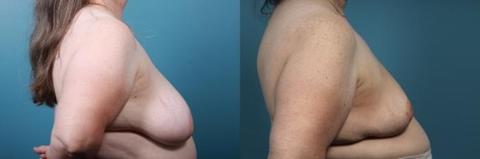 Before & After Breast Reconstruction Case 45 View #4 View in Portland, OR