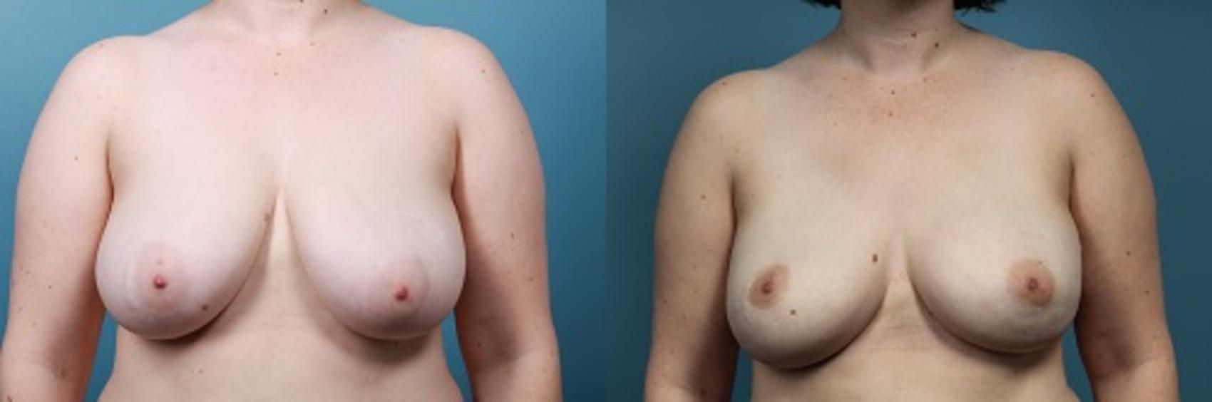 Before & After Breast Reconstruction Case 46 View #1 View in Portland, OR