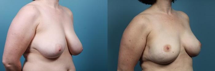 Before & After Breast Reconstruction Case 46 View #2 View in Portland, OR