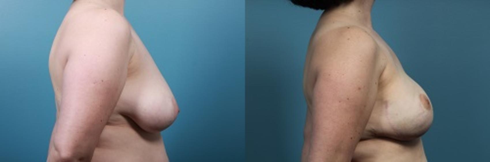 Before & After Breast Reconstruction Case 46 View #3 View in Portland, OR