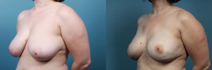 Before & After Breast Reconstruction Case 46 View #4 View in Portland, OR