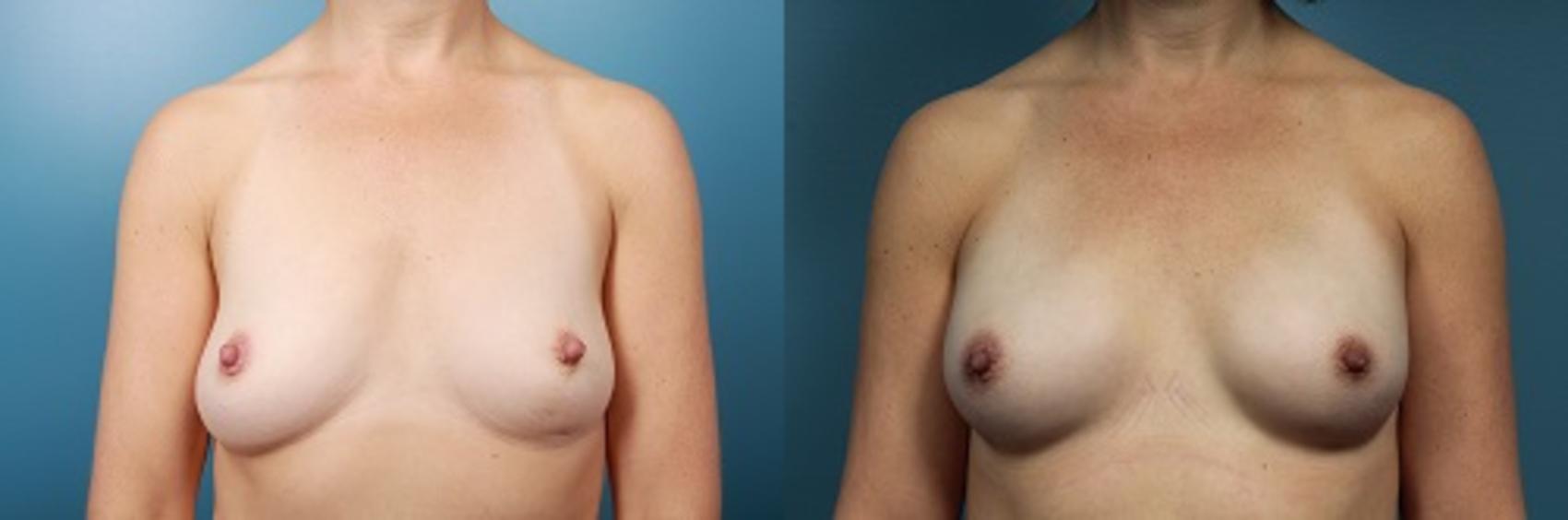 Before & After Breast Reconstruction Case 47 View #1 View in Portland, OR
