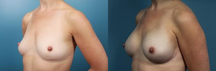 Before & After Breast Reconstruction Case 47 View #3 View in Portland, OR