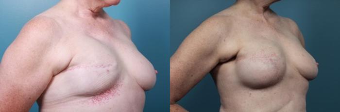 Before & After Breast Reconstruction Case 48 View #2 View in Portland, OR
