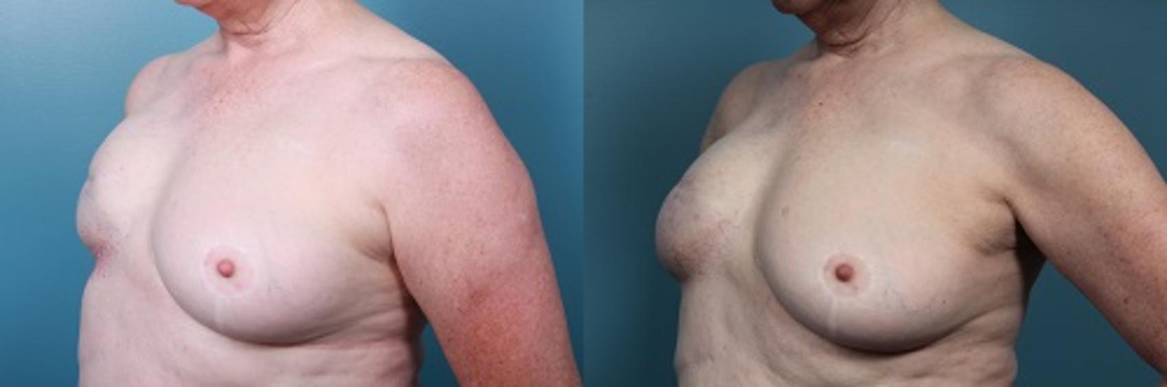 Before & After Breast Reconstruction Case 48 View #3 View in Portland, OR