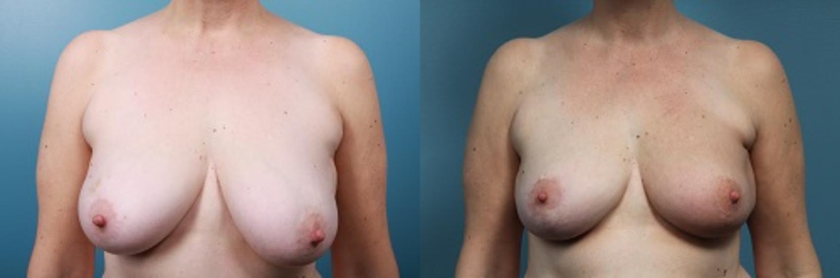 Before & After Breast Reconstruction Case 50 View #1 View in Portland, OR