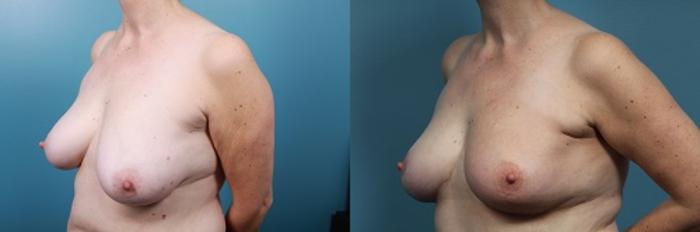 Before & After Breast Reconstruction Case 50 View #2 View in Portland, OR