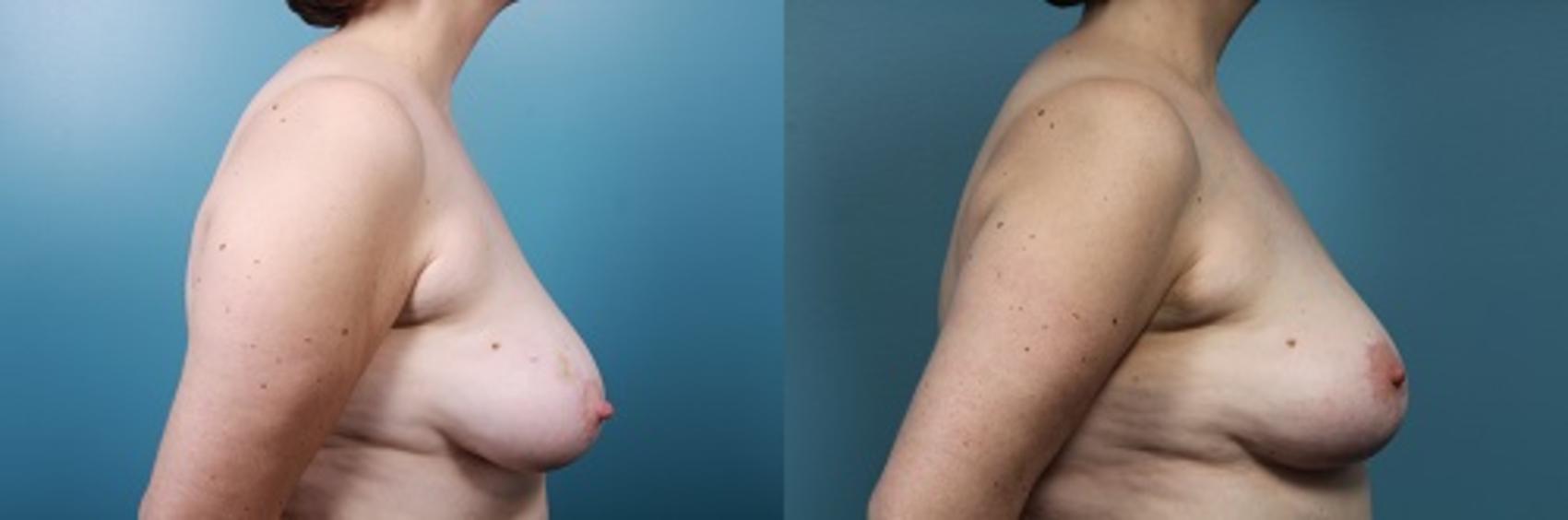 Before & After Breast Reconstruction Case 50 View #3 View in Portland, OR