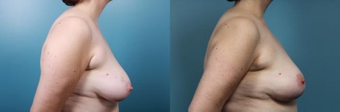 Before & After Breast Reconstruction Case 50 View #3 View in Portland, OR