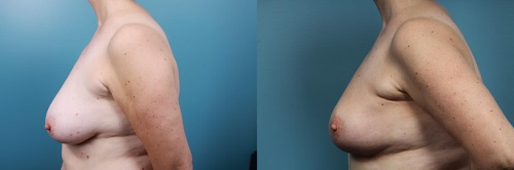 Before & After Breast Reconstruction Case 50 View #4 View in Portland, OR