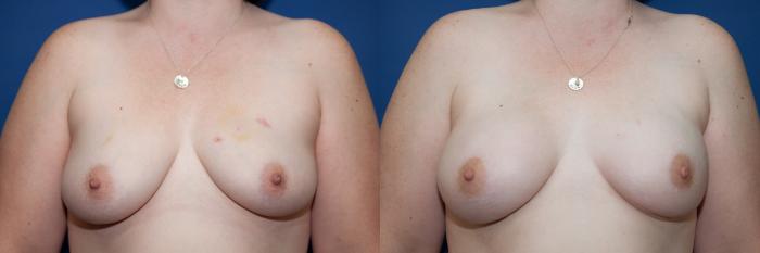 Before & After Breast Reconstruction Case 6 View #1 View in Portland, OR