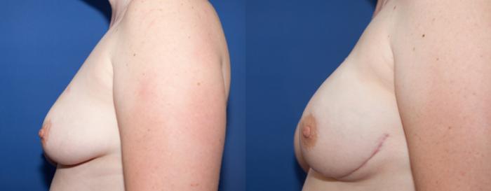 Before & After Breast Reconstruction Case 6 View #2 View in Portland, OR