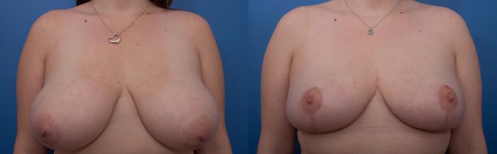 Before & After Breast Reduction Case 10 View #1 View in Portland, OR