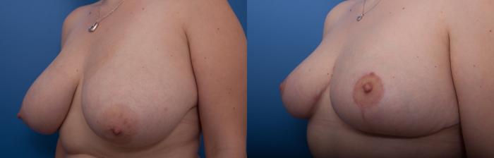 Before & After Breast Reduction Case 10 View #2 View in Portland, OR