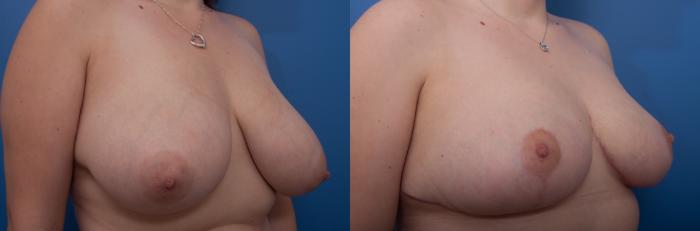 Before & After Breast Reduction Case 10 View #3 View in Portland, OR