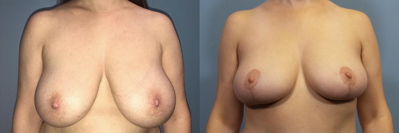 Before & After Breast Reduction Case 108 View #1 View in Portland, OR