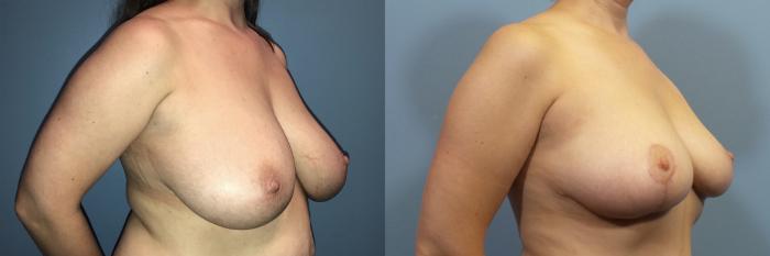 Before & After Breast Reduction Case 108 View #2 View in Portland, OR
