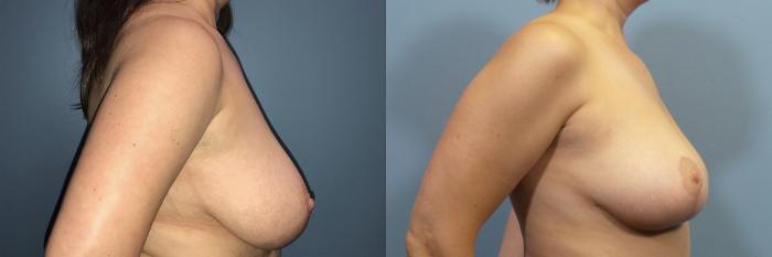 Before & After Breast Reduction Case 108 View #3 View in Portland, OR