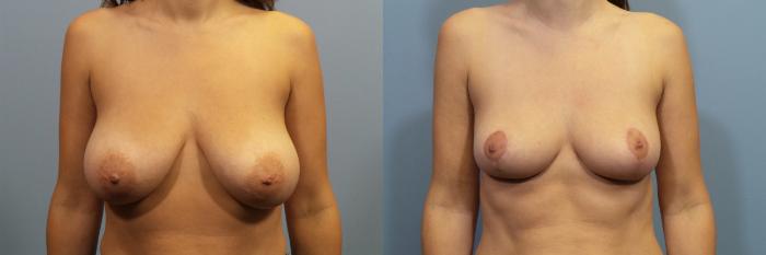Before & After Breast Reduction Case 112 View #1 View in Portland, OR