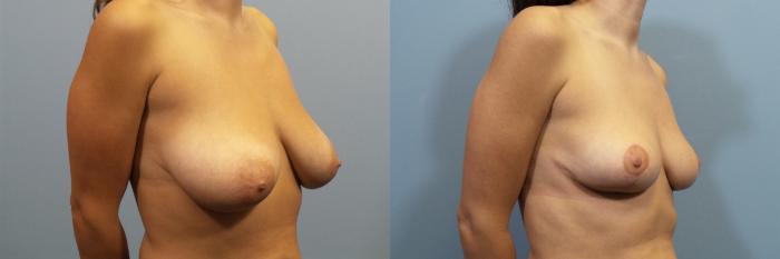 Before & After Breast Reduction Case 112 View #2 View in Portland, OR