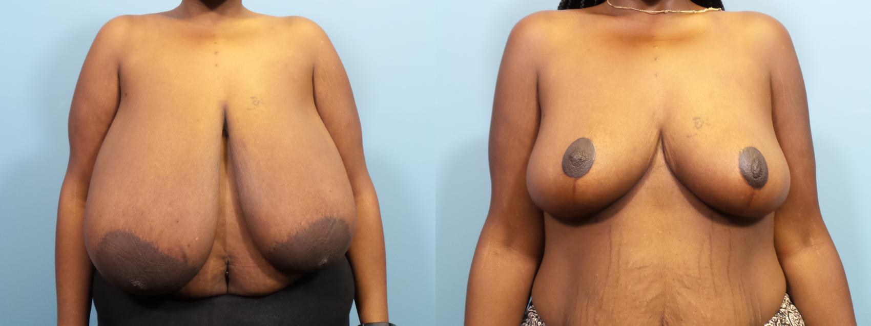 Before & After Breast Reduction Case 114 View #1 View in Portland, OR