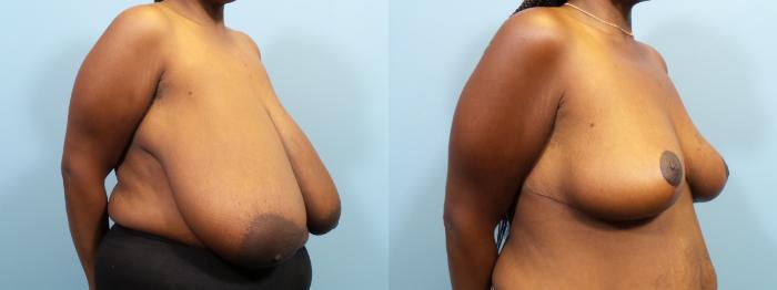 Before & After Breast Reduction Case 114 View #2 View in Portland, OR