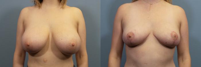 Before & After Breast Reduction Case 122 View #1 View in Portland, OR